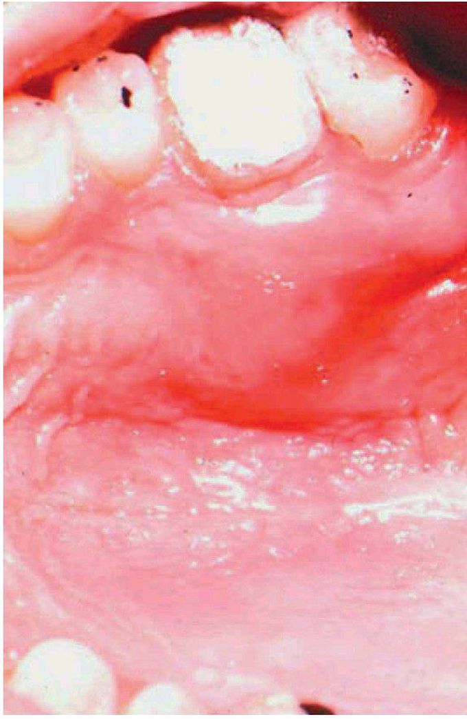 Palatal space infection