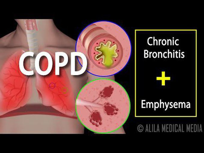 COPD description of chronic obstructive pulmonary disease