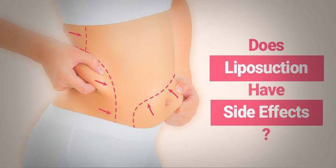 Side effects of liposuction