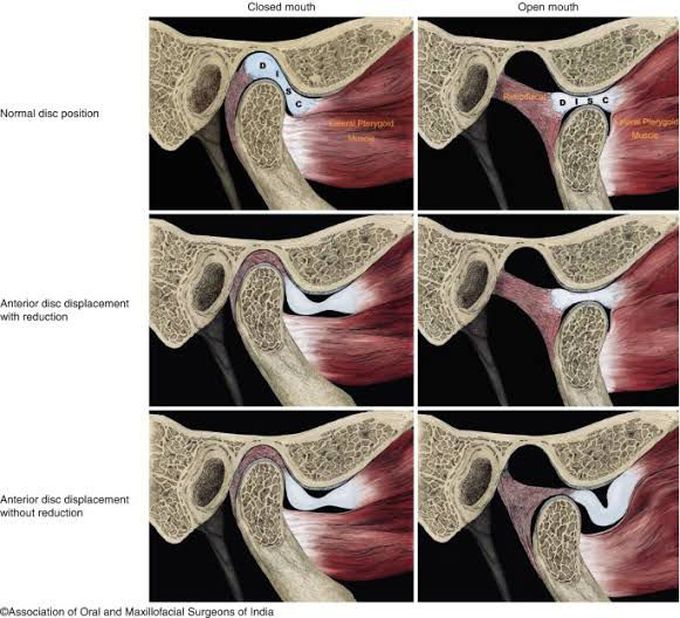 Treatment of internal derangement of TMJ