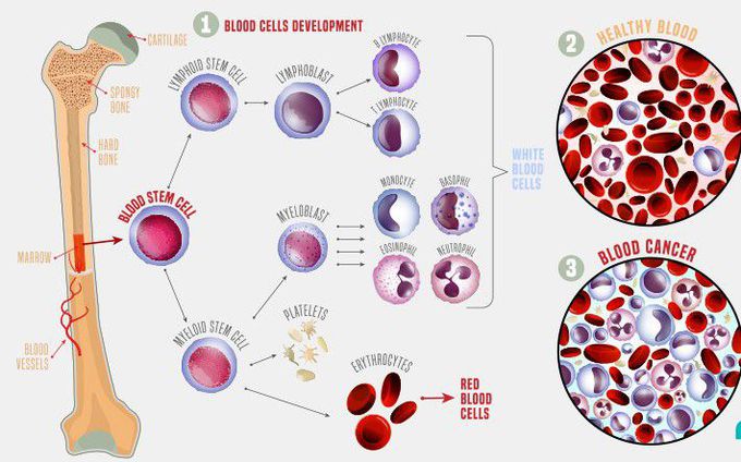 Symptoms of Hairy cell leukemia