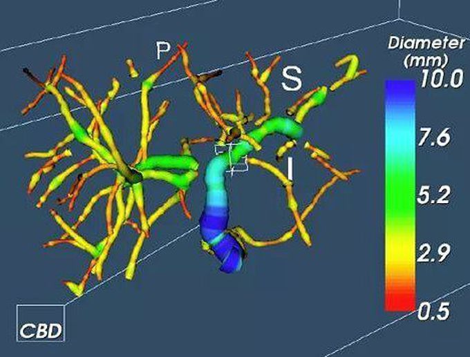 MRCP+ (quantitative MRCP) : Diagnosing and Monitoring Biliary Disorders