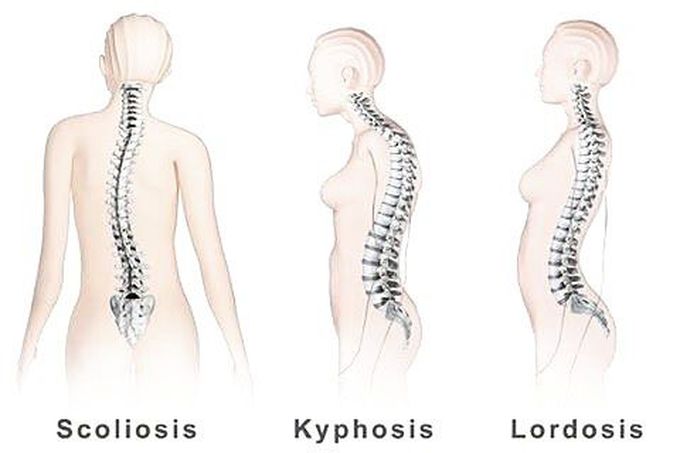 Spine Conditions