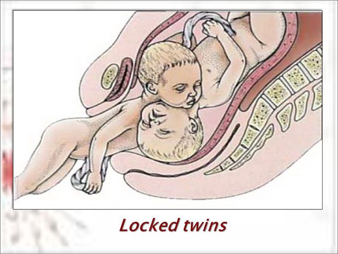Locked twins
