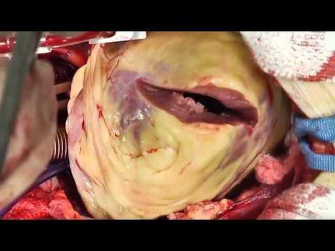 Apical Myectomy for Nonobstructive Hypertrophic Cardiomyopathy
