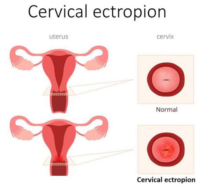 Cervical ectropion