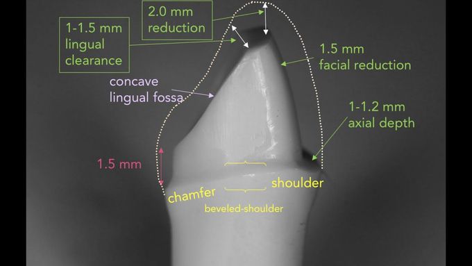 Anterior PFM Preparation