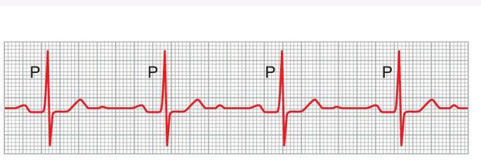 First degree heart block