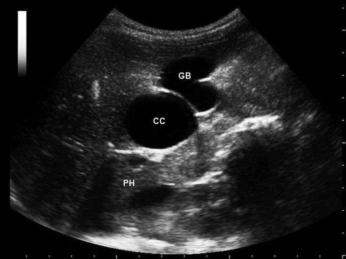 Choledochal Cysts