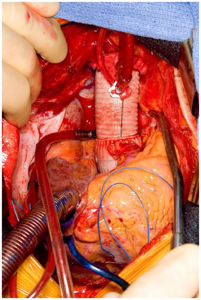Aortic Dissection
