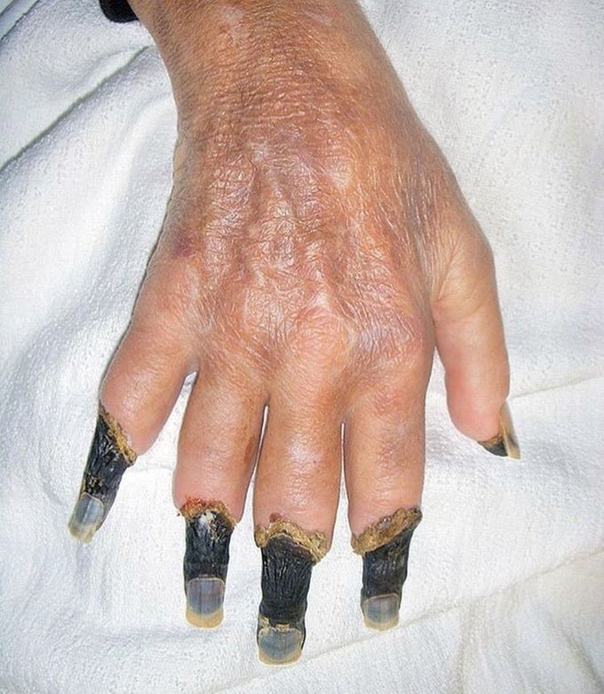 Waldenström's macroglobulinemia.
