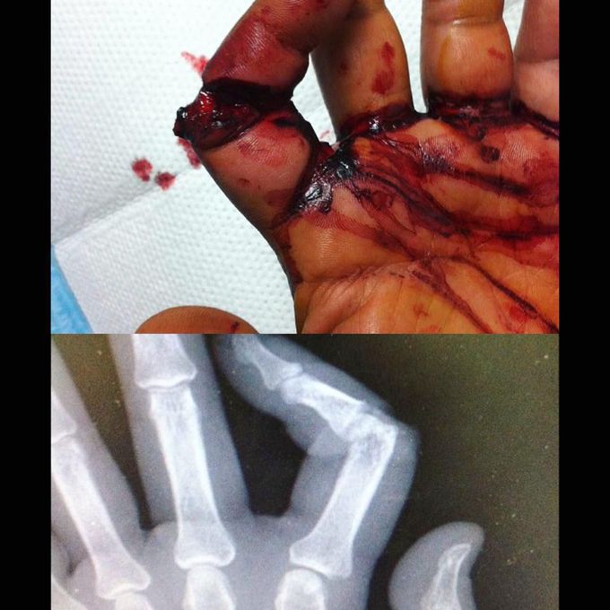 Finger injury
