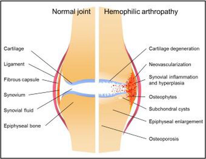 Cause of Hemophilic arthropathy