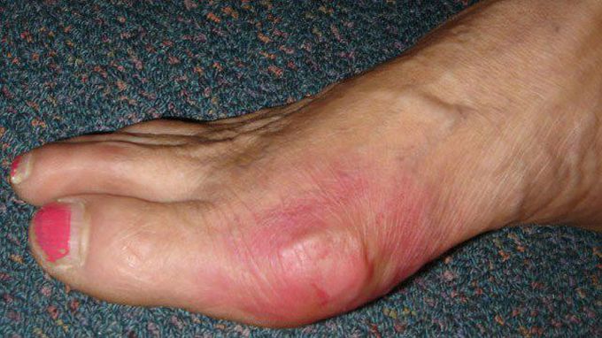 Triggers Causing Acute Flares of Gout