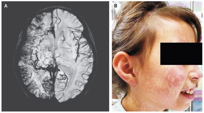 Sturge–Weber Syndrome