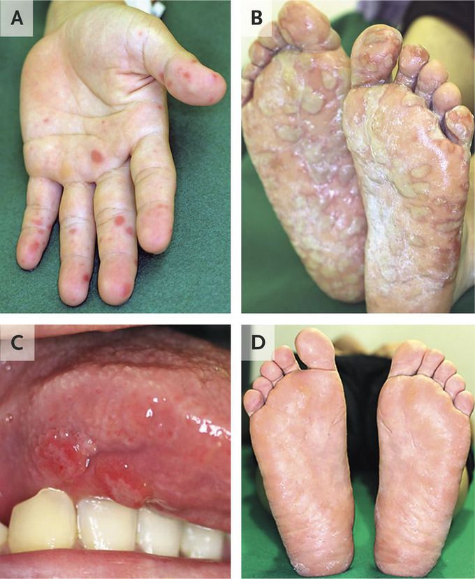 Hand, Foot, and Mouth Disease in an Adult