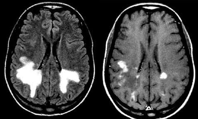 Treatment of schilders sclerosis