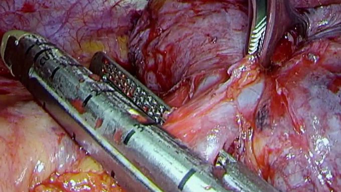 VATS Left Pneumonectomy
