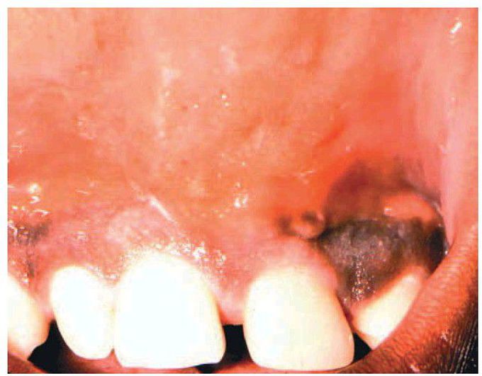 Odontogenic infection