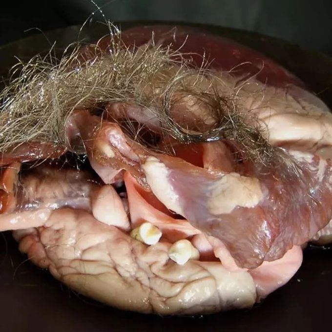 ovarian cyst with hair and teeth