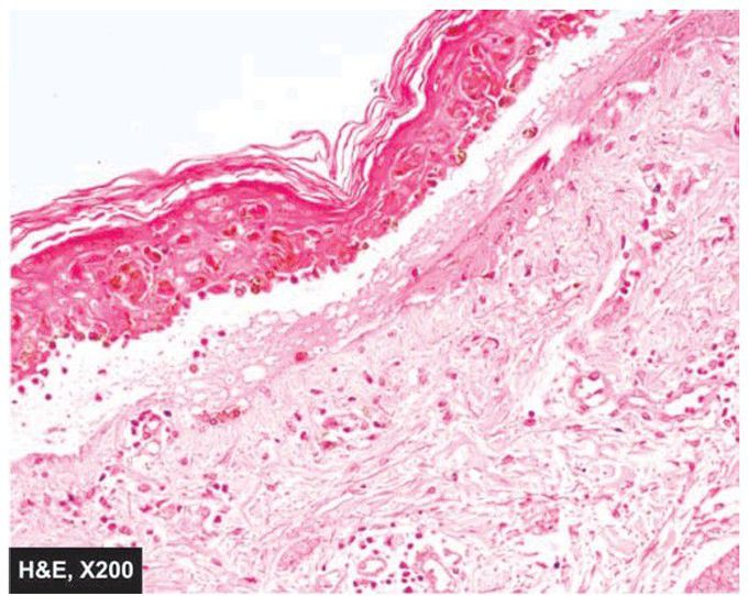 Erythema multiforme.