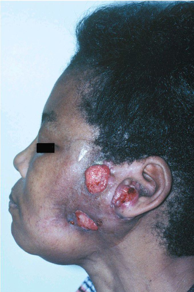 Carcinoma Arising in a Cyst.