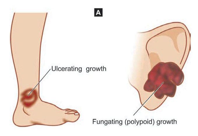 Squamous cell carcinoma