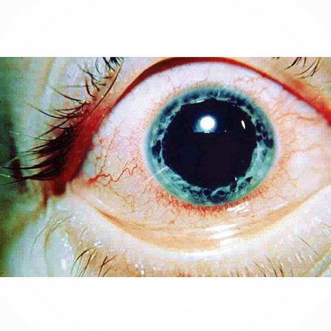Acute anterior uveitis in a patient with ankylosing spondylitis