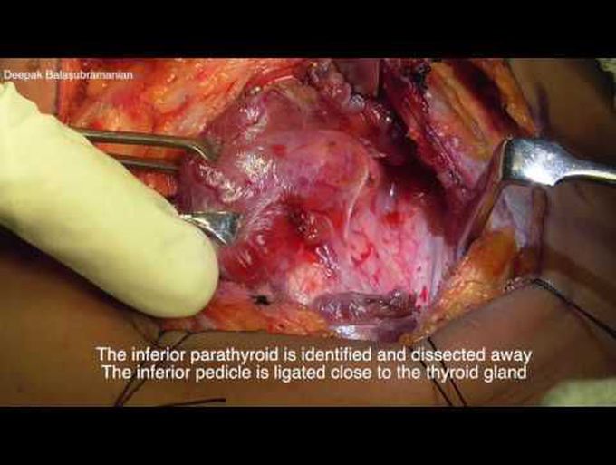 Thyroidectomy