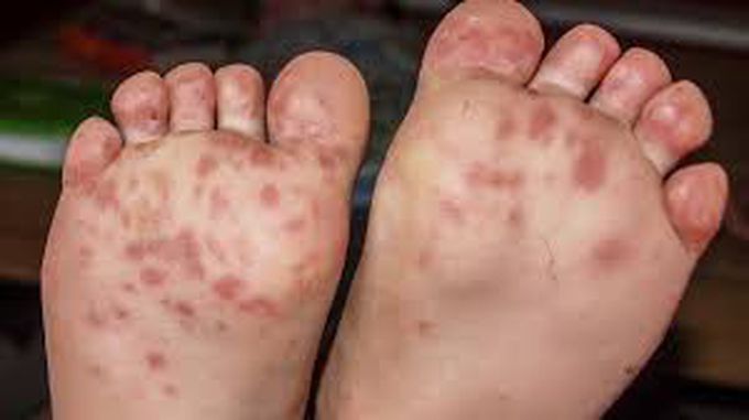 Hand foot and mouth disease