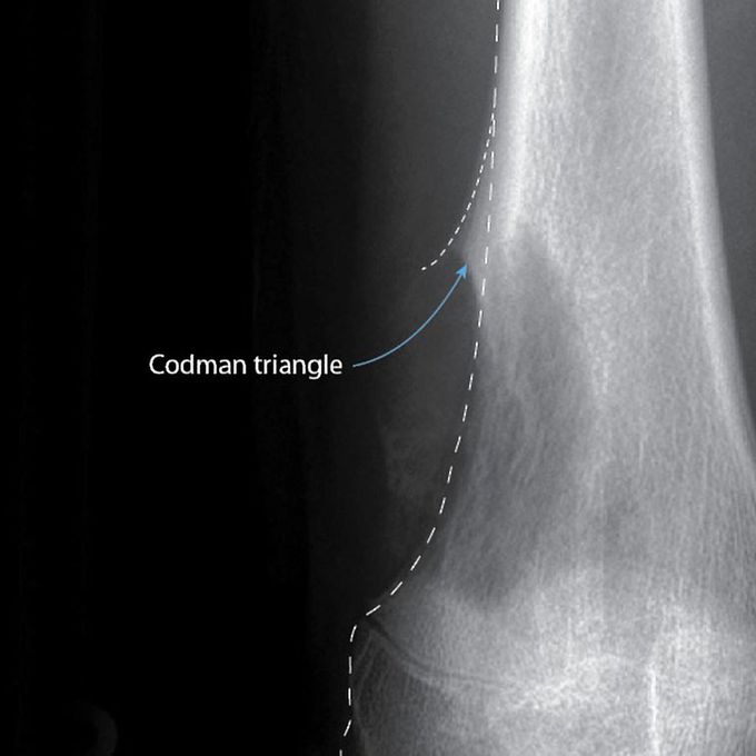 Codman Triangle - A Radiologic Sign