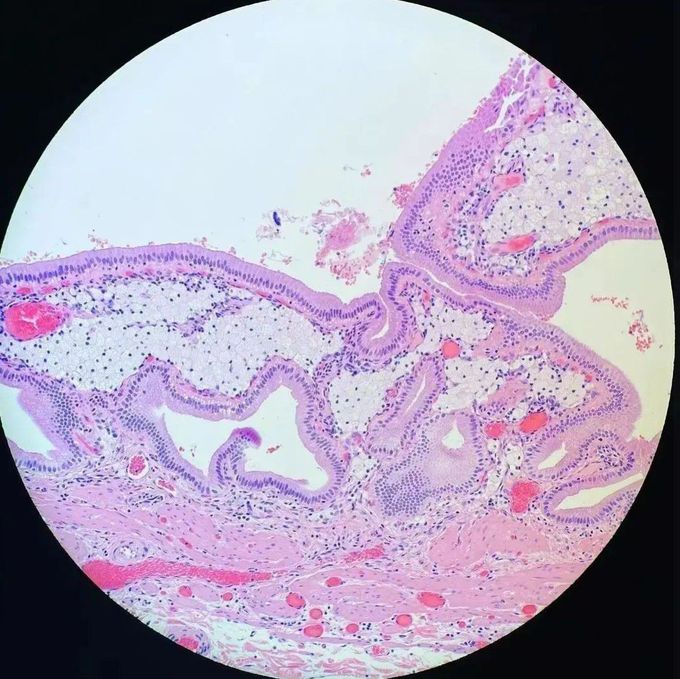 What is this finding in a gallbladder?