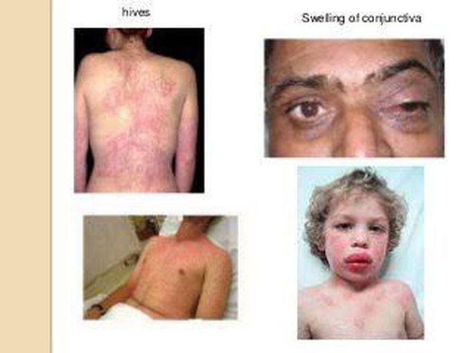 Anaphylaxis