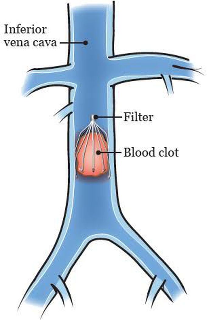 Prevention of pulmonary embolism