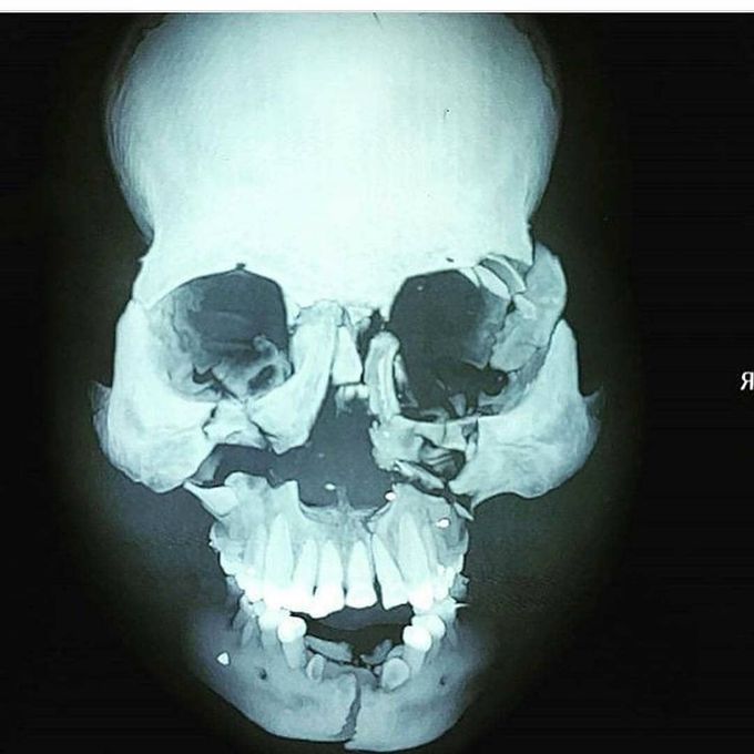 Panfacial fractures 😷😷