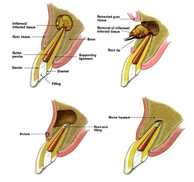 Why apicoectomy is done?