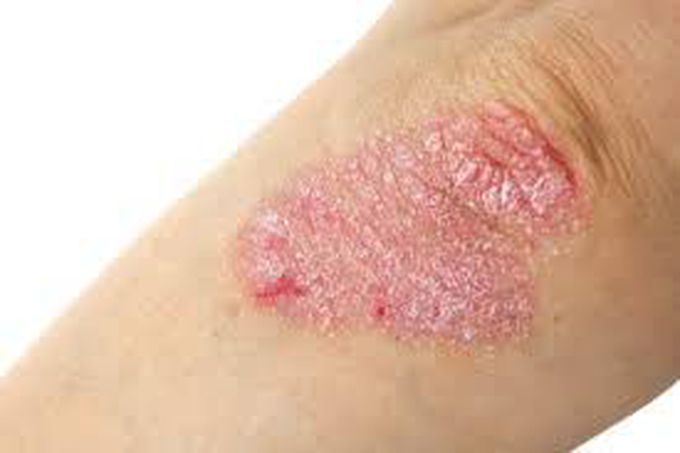 Anhidrosis