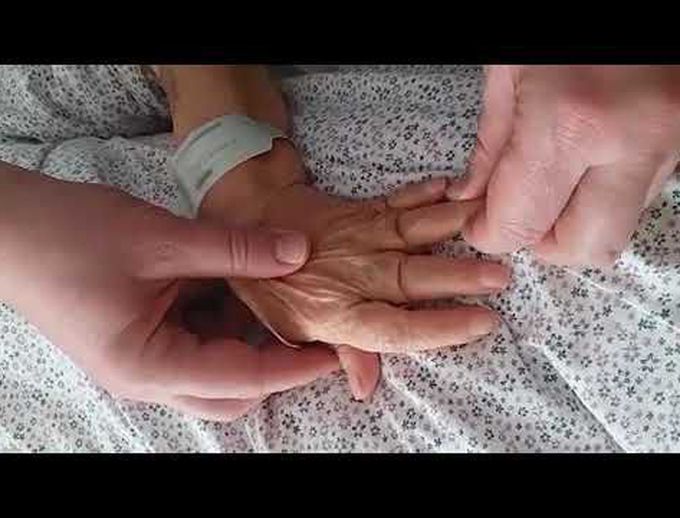 Telescoping Fingers in Rheumatoid Arthritis