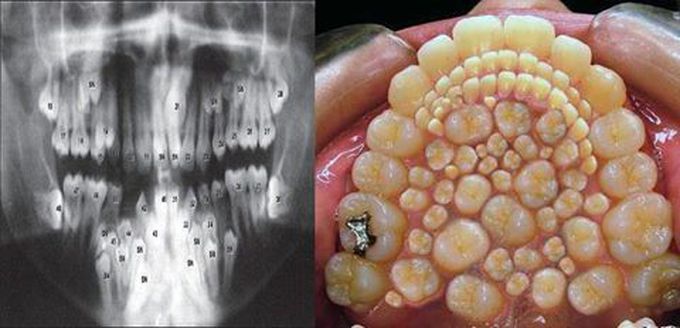 Hyperodontia