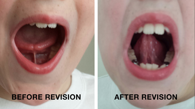 Treatment For Lingual Frenulum Medizzy