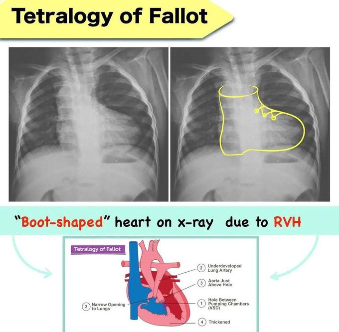 Teratology of Fallot