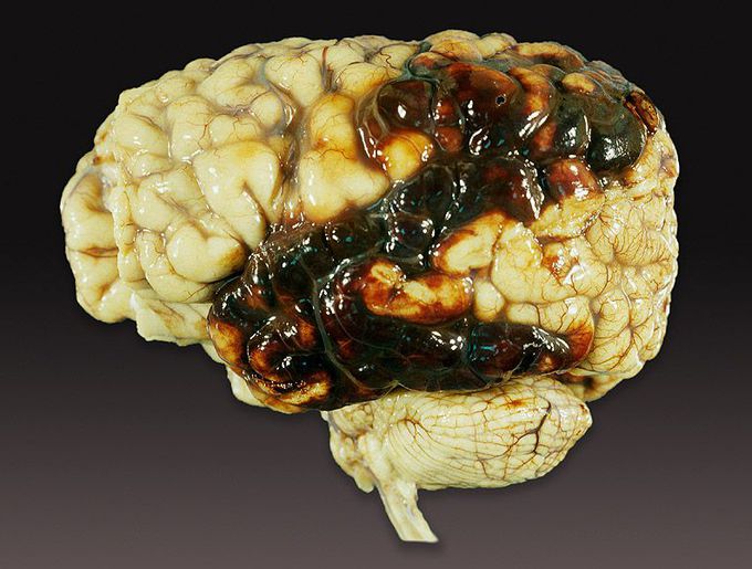 INTRACRANIAL HEMORRHAGE (ICH)