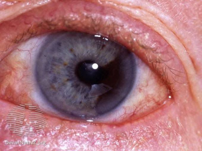 Eye cancer symptoms