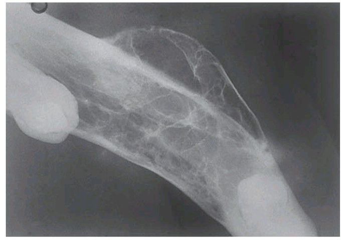 Odontogenic myxoma of the mandible.