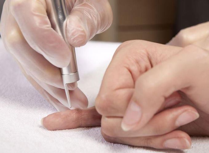 Treatment for warts
