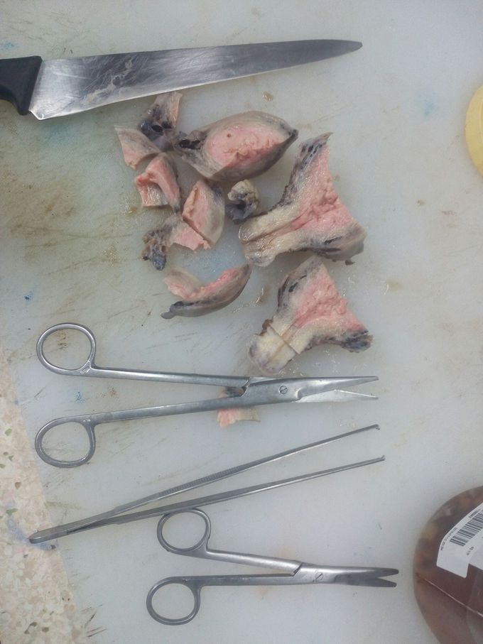 Uterine cancer