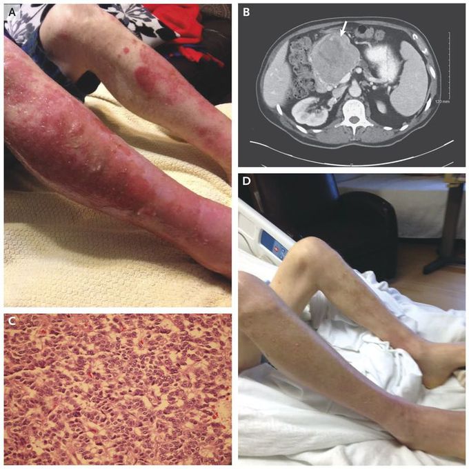 Glucagonoma-Associated Rash