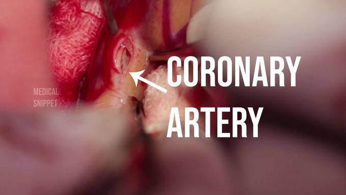 Coronary Artery