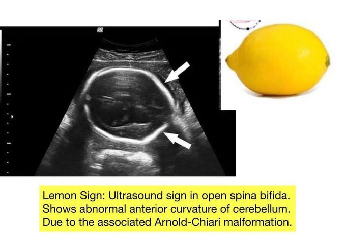 Lemon Sign