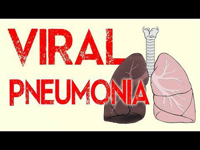 Presentation of Viral Pneumonia - Animation